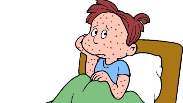 La varicella e i suoi scomodi puntini rossi: come scoprirla e curarla